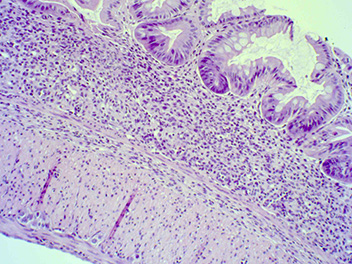 Severe colitis (DSS administered, treated with vehicle), 100x